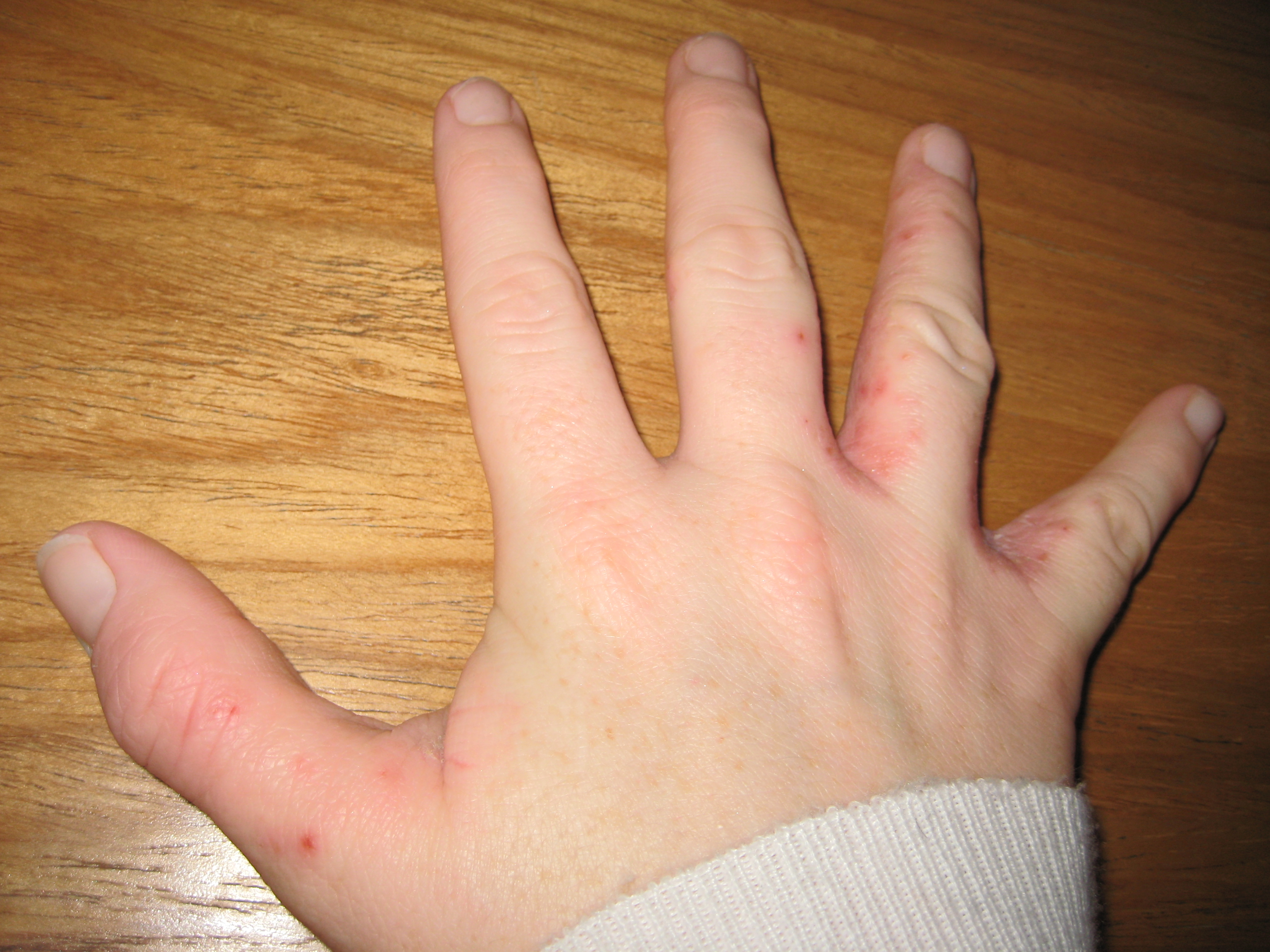 Remedy for Eczema of the Fingers | eHow
